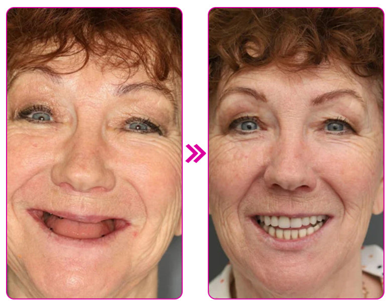 Dobshow™🔥New Year Special Offer🔥- 𝕤𝕒𝕧𝕖 𝕦𝕡 𝕥𝕠 -𝟞𝟝% 🅾🅵🅵 Thermoplastic Denture Adhesive